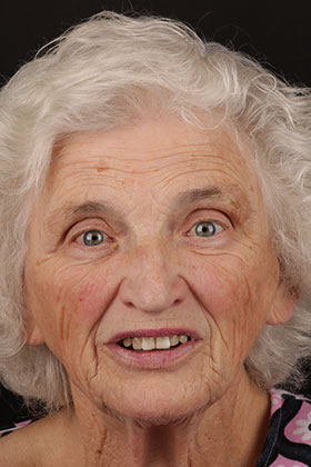 Before and after smile transformation by Advanced Dental Implant and TMJ Center in Southaven, MS.